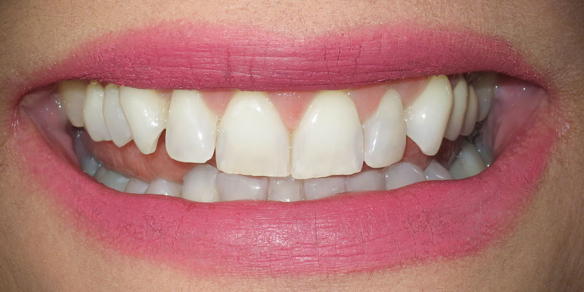 Procelain Veneers | Clark Dental
