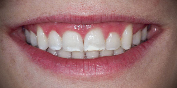 Gummy Smile | Clark Dental