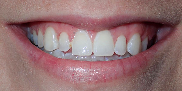 Procelain Veneers | Clark Dental